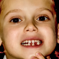 Adam 2005 Missing Teeth